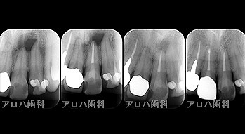 透過像が消失したケース